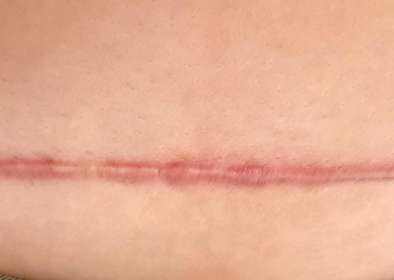 cicatriz hipertrófica